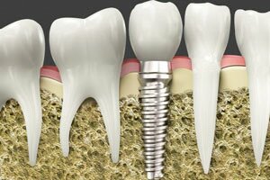 Options for Missing Teeth