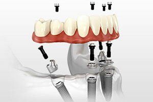 Dr. Charles Flowers offers denture patients revolutionary All-on-4 dental implants. The All-on-4 procedure was developed in the 1990s to help patients without teeth rapidly regain a fully functional mouth and jaw.