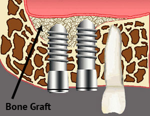 Dental Implant Treatment