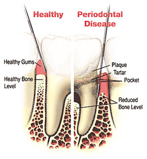 Cleanings & Gum Disease Treatment