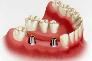 Options for Missing Teeth