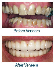 Porcelain Veneers