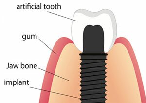 Dental Implants