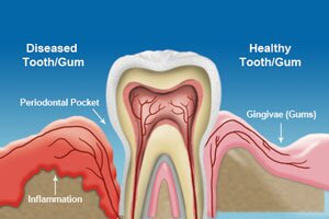 Cleanings & Gum Disease Treatment