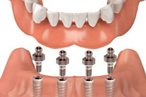 implant dentures