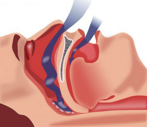 Sleep Apnea & Snoring Treatment