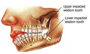 Tooth Extractions